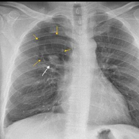 Chest radiograph (PA view)
