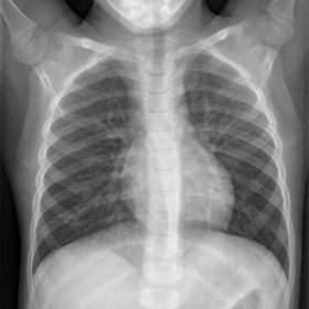 Chest X-ray