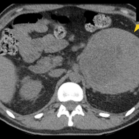 CT images with and without iv contrast medium.