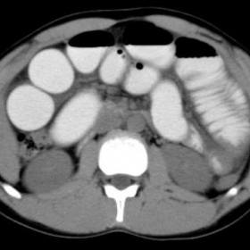 CT images at the level of upper abdomen