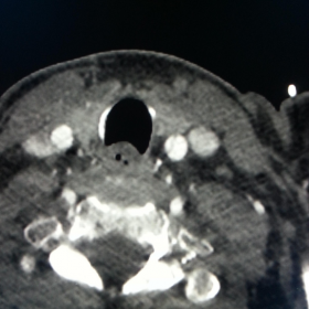 Bilateral Carotid Angiogram