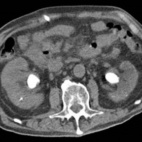 Axial CT of the abdomen