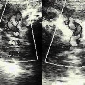 Antenatal sonography of fetal cord