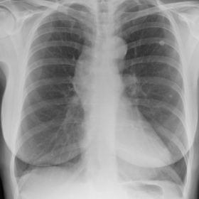 X-ray chest PA view (2009)