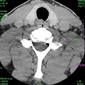 Cervical spine CT