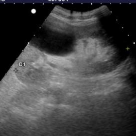 Previous outpatient abdominal ultrasound (4 months earlier)