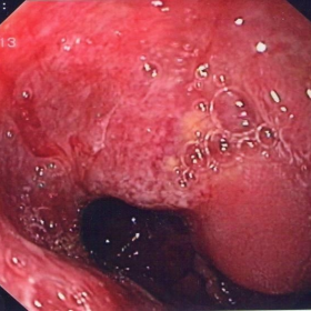 Upper gastrointestinal (GI) endoscopy