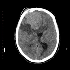Axial CT brain
