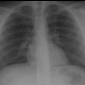Posteroanterior and lateral chest X-rays