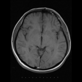 MRI images