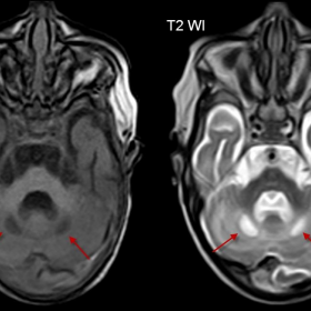 T1 and T2 WIs of selected brain areas