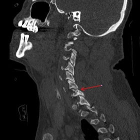 CT cervical spine sagittal reconstruction
