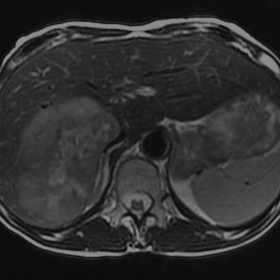 Liver metastasis from rectal neuroendocrine carcinoma (right lobe).