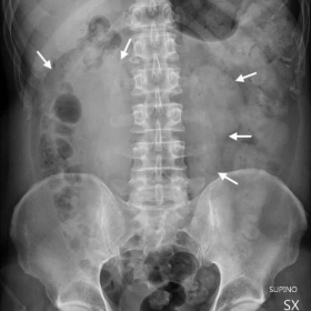 Plain abdominal radiographs