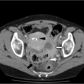 Axial contrast enhanced CT of the Pelvis