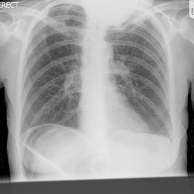 Initial AP erect chest radiograph