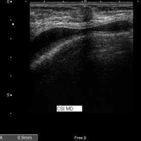 US of palpable lump in the right breast