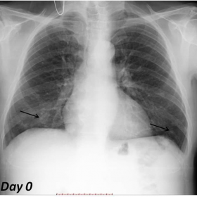 Day 0 - Posteroanterior and lateral chest radiographs