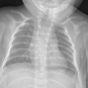 Chest Radiography