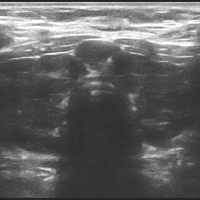 Ultrasonography of thyroid with high frequency linear transducer (5-14MHz).