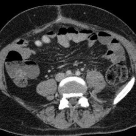 Enhanced CT of the abdomen and pelvis on admission