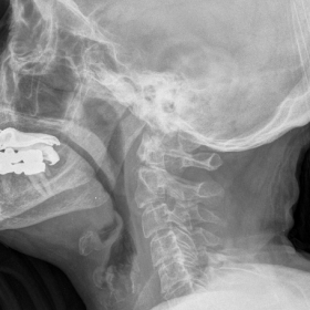 Plain radiography of the cervical spine