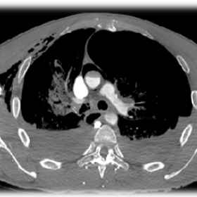 Chest CT examination with contrast
