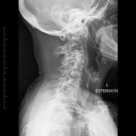 Lateral C spine radiographs
