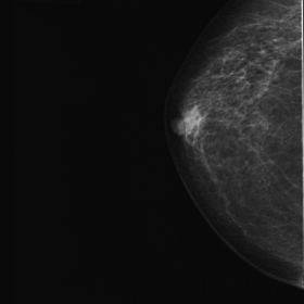 Cranial-caudal and mediolateral oblique mammogram