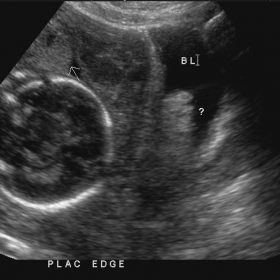 Sagittal ultrasound of the pelvis