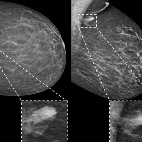 Mammography of the left breast