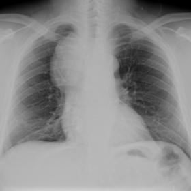 Chest radiograph - frontal view