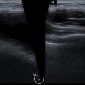 Ultrasound study of the right implant – stepladder sign