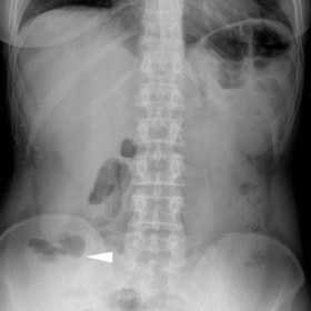 Initial plain abdominal radiographs in emergency department