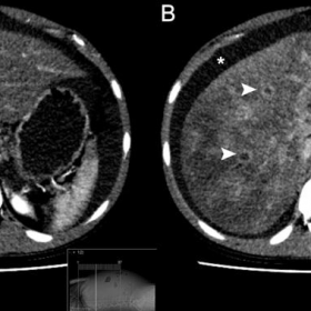 CT in arterial phase (A) and portal-venous phase (B).