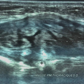 Ultrasound of the chest wall