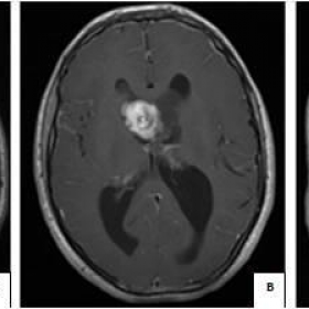 Subependymal giant cell astrocytoma