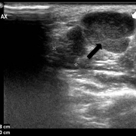 Grey scale ultrasound