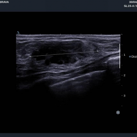 Ultrasound imaging