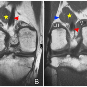Coronal T1W images, anterior (A) to posterior (D).
