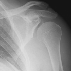 Anteroposterior left shoulder radiography