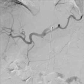 Coeliac trunk arteriogram