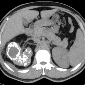 Axial Non-enhanced CT of abdomen and pelvis
