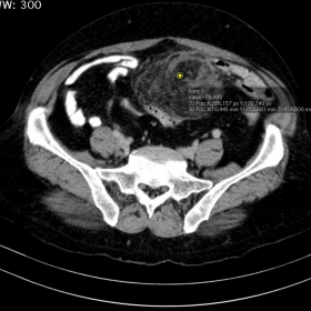 Non-enhanced CT, axial plane of abdomen and pelvis