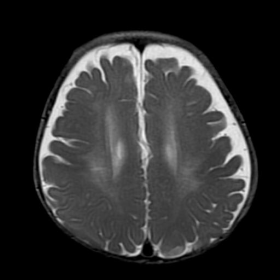 MRI - Axial T2 images