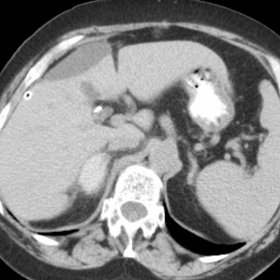 CT of the abdomen at the adrenals level