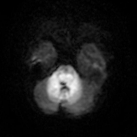 Axial diffusion-weighted MR image