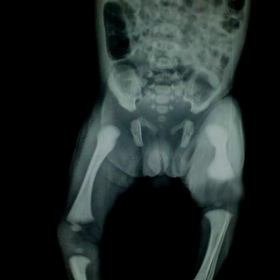 X-ray lower limbs