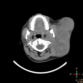 Contrast-enhanced axial CT at level of C1 vertebra
