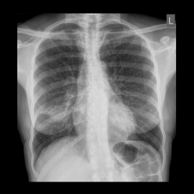 Initial and follow-up chest X-ray